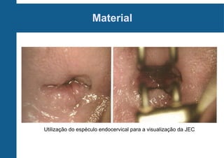 Material
Utilização do espéculo endocervical para a visualização da JECt
 