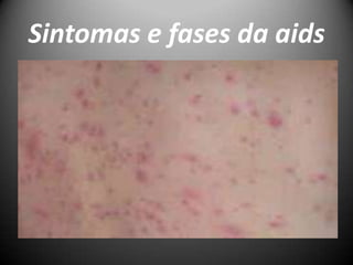 Sintomas e fases da aids
 