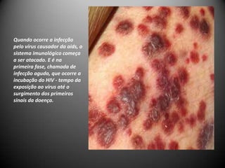 Quando ocorre a infecção
pelo vírus causador da aids, o
sistema imunológico começa
a ser atacado. E é na
primeira fase, chamada de
infecção aguda, que ocorre a
incubação do HIV - tempo da
exposição ao vírus até o
surgimento dos primeiros
sinais da doença.
 