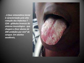 . A fase sintomática inicial
é caracterizada pela alta
redução dos linfócitos T
CD4 - glóbulos brancos do
sistema imunológico - que
chegam a ficar abaixo de
200 unidades por mm³ de
sangue. Em adultos
saudáveis,
 