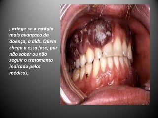 , atinge-se o estágio
mais avançado da
doença, a aids. Quem
chega a essa fase, por
não saber ou não
seguir o tratamento
indicado pelos
médicos,
 