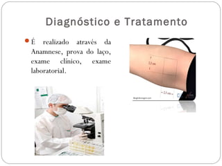 Diagnóstico e Tratamento
É   realizado através da
 Anamnese, prova do laço,
 exame clínico, exame
 laboratorial.
 