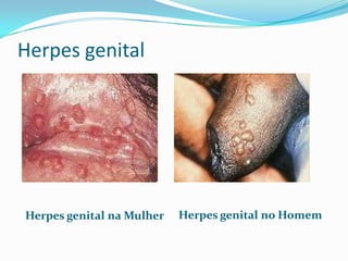 Herpes genitalHerpes genital no HomemHerpes genital na Mulher