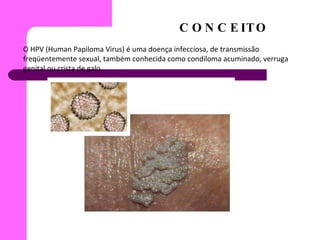 CONCEITO O HPV (Human Papiloma Virus) é uma doença infecciosa, de transmissão freqüentemente sexual, também conhecida como condiloma acuminado, verruga genital ou crista de galo . 