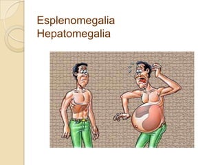Esplenomegalia
Hepatomegalia
 