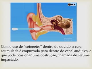 Com o uso de “cotonetes” dentro do ouvido, a cera
acumulada é empurrada para dentro do canal auditivo, o
que pode ocasionar uma obstrução, chamada de cerume
impactado.
 