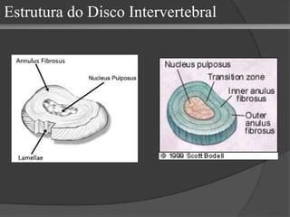 Estrutura do Disco Intervertebral
 