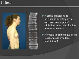 Cifose
 A cifose torácica pode
originar-se de osteoporose,
osteocondrose espinhal
(Scheüermann), maus hábitos
posturais, traumas.
 Acredita-se também que possa
resultar de deformidade
multifatorial.
 
