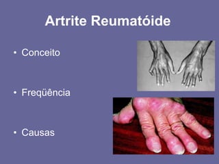 Conceito Freqüência Causas Artrite Reumatóide  