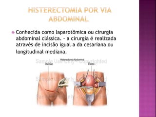  Conhecida como laparotômica ou cirurgia 
abdominal clássica. - a cirurgia é realizada 
através de incisão igual a da cesariana ou 
longitudinal mediana. 
 