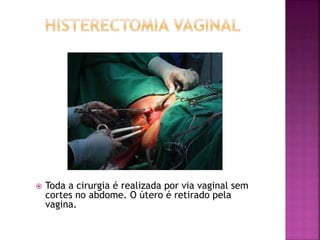  Toda a cirurgia é realizada por via vaginal sem 
cortes no abdome. O útero é retirado pela 
vagina. 
 