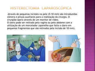 Através de pequenas incisões na pele (5-10 mm) são introduzidas 
câmera e pinças auxiliares para a realização da cirurgia. O 
cirurgião opera através de um monitor de vídeo. 
O útero pode ser retirado pela vagina ou pelo abdome com a 
utilização de um morcelador (aparelho que fatia o útero em 
pequenos fragmentos que são retirados pela incisão de 10 mm). 
 
