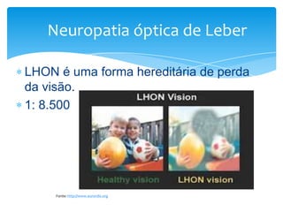 Neuropatia óptica de Leber
LHON é uma forma hereditária de perda
da visão.
1: 8.500

Fonte: http://www.eurordis.org

 