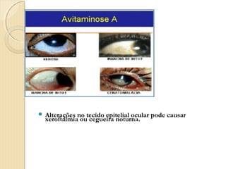  Alterações no tecido epitelial ocular pode causar
  xeroftalmia ou cegueira noturna.
 