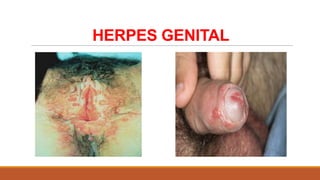 HERPES GENITAL

 