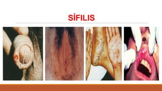 SÍFILIS

 