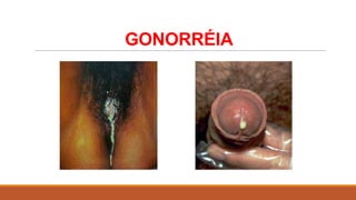 GONORRÉIA

 