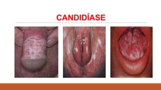 CANDIDÍASE

 