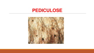 PEDICULOSE

 