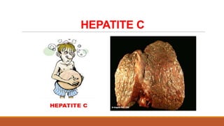 HEPATITE C

 