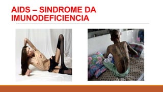 AIDS – SINDROME DA
IMUNODEFICIENCIA

 
