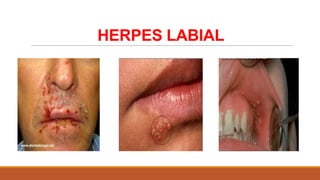 HERPES LABIAL

 