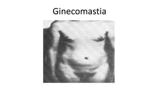 Ginecomastia
 