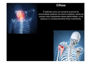 Cifose
É definida como um aumento anormal da
concavidade posterior da coluna vertebral, sendo as
causas mais importantes dessa deformidade, a má
postura e o condicionamento físico insuficiente.

 