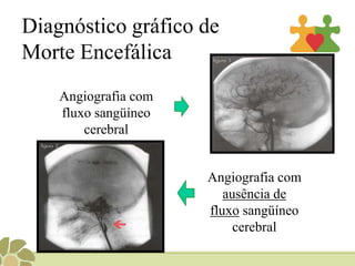 Diagnóstico gráfico de Morte EncefálicaAngiografia com fluxosangüíneo cerebralAngiografia com ausência de fluxosangüíneo cerebral 