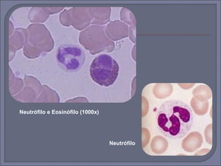 Neutrófilo e Eosinófilo (1000x) 
Neutrófilo 
 