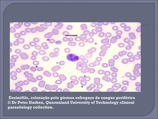 Eosinófilo, coloração pelo giemsa esfregaço de sangue periférico 
© Dr Peter Darben, Queensland University of Technology clinical 
parasitology collection. 
 