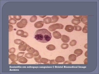 Eosinófilo em esfregaço sanguíneo © Bristol Biomedical Image 
Archive 
 