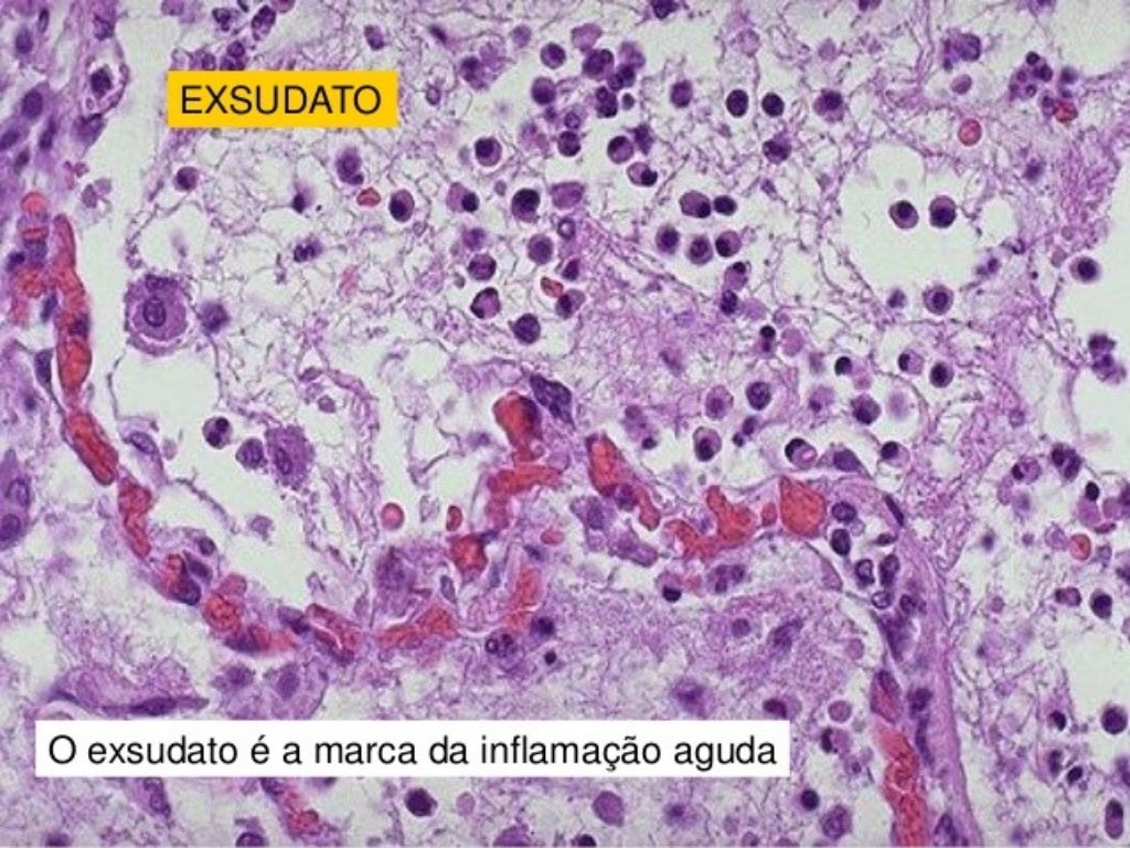 INFLAMAÇÃO AGUDA E CRÔNICA