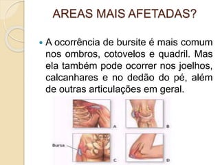 AREAS MAIS AFETADAS?
 A ocorrência de bursite é mais comum
nos ombros, cotovelos e quadril. Mas
ela também pode ocorrer nos joelhos,
calcanhares e no dedão do pé, além
de outras articulações em geral.
 