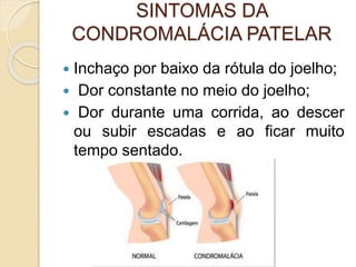 SINTOMAS DA
CONDROMALÁCIA PATELAR
 Inchaço por baixo da rótula do joelho;
 Dor constante no meio do joelho;
 Dor durante uma corrida, ao descer
ou subir escadas e ao ficar muito
tempo sentado.
 