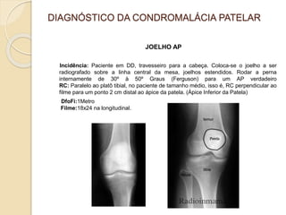 DIAGNÓSTICO DA CONDROMALÁCIA PATELAR
JOELHO AP
Incidência: Paciente em DD, travesseiro para a cabeça. Coloca-se o joelho a ser
radiografado sobre a linha central da mesa, joelhos estendidos. Rodar a perna
internamente de 30º à 50º Graus (Ferguson) para um AP verdadeiro
RC: Paralelo ao platô tibial, no paciente de tamanho médio, isso é, RC perpendicular ao
filme para um ponto 2 cm distal ao ápice da patela. (Ápice Inferior da Patela)
DfoFi:1Metro
Filme:18x24 na longitudinal.
 