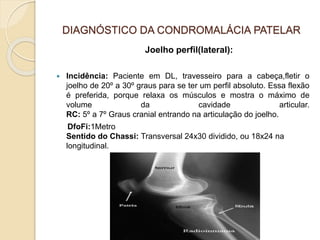 DIAGNÓSTICO DA CONDROMALÁCIA PATELAR
Joelho perfil(lateral):
 Incidência: Paciente em DL, travesseiro para a cabeça,fletir o
joelho de 20º a 30º graus para se ter um perfil absoluto. Essa flexão
é preferida, porque relaxa os músculos e mostra o máximo de
volume da cavidade articular.
RC: 5º a 7º Graus cranial entrando na articulação do joelho.
DfoFi:1Metro
Sentido do Chassi: Transversal 24x30 dividido, ou 18x24 na
longitudinal.
 