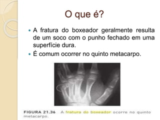 O que é?
 A fratura do boxeador geralmente resulta
de um soco com o punho fechado em uma
superfície dura.
 É comum ocorrer no quinto metacarpo.
 