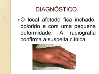 DIAGNÓSTICO
O local afetado fica inchado,
dolorido e com uma pequena
deformidade. A radiografia
confirma a suspeita clínica.
 