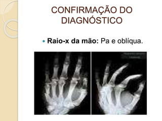 CONFIRMAÇÃO DO
DIAGNÓSTICO
 Raio-x da mão: Pa e oblíqua.
 