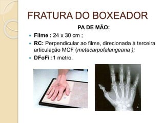 FRATURA DO BOXEADOR
PA DE MÃO:
 Filme : 24 x 30 cm ;
 RC: Perpendicular ao filme, direcionada à terceira
articulação MCF (metacarpofalangeana );
 DFoFi :1 metro.
 