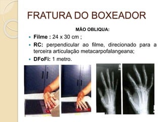 FRATURA DO BOXEADOR
MÃO OBLIQUA:
 Filme : 24 x 30 cm ;
 RC: perpendicular ao filme, direcionado para a
terceira articulação metacarpofalangeana;
 DFoFi: 1 metro.
 
