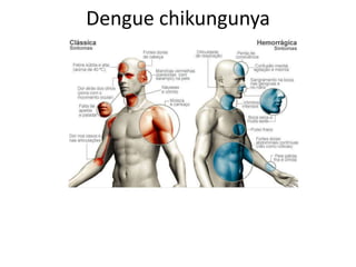 Dengue chikungunya
 