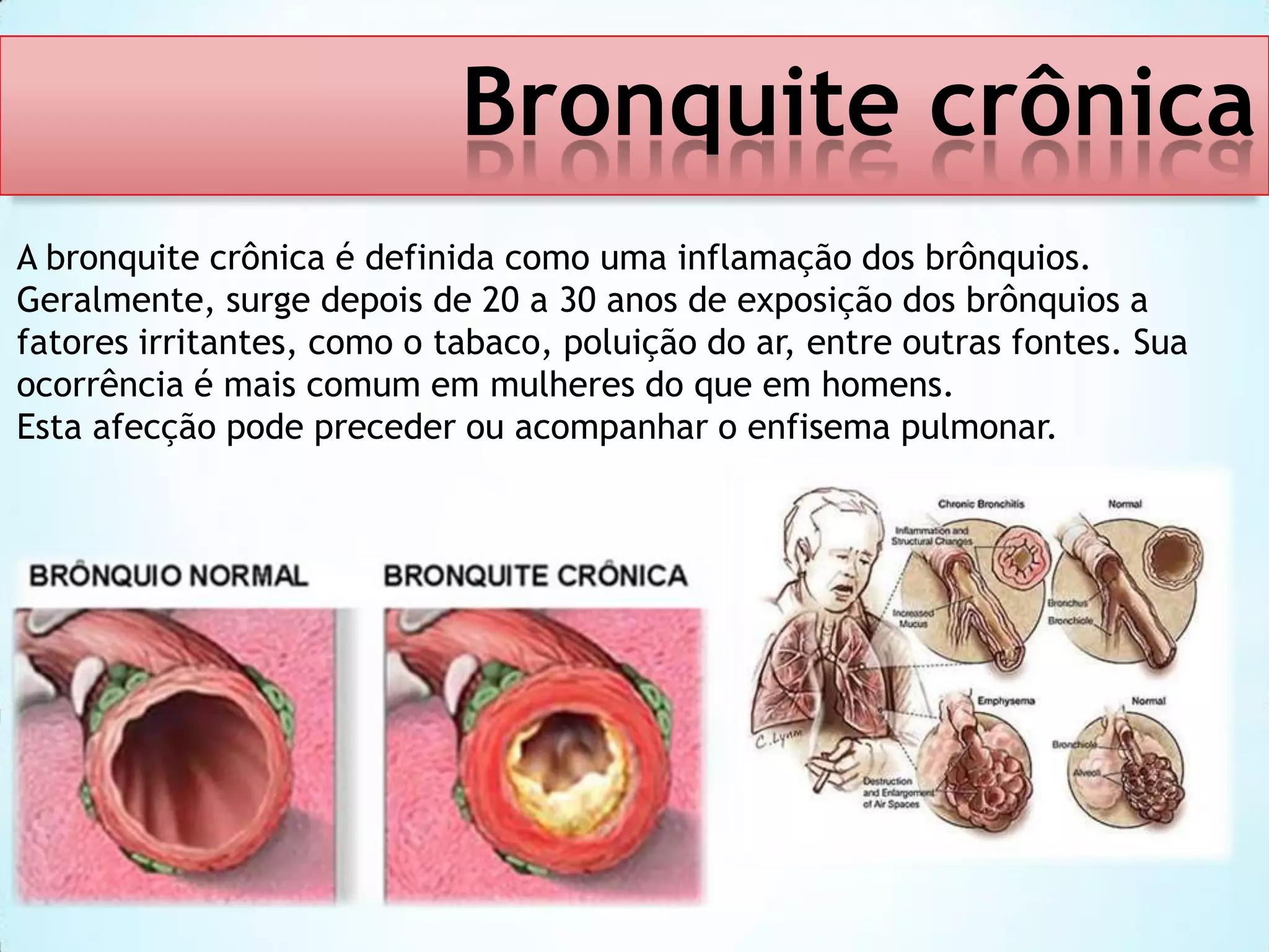 Bronquite crônica
A bronquite crônica é definida como uma inflamação dos brônquios.
Geralmente, surge depois de 20 a 30 anos de exposição dos brônquios a
fatores irritantes, como o tabaco, poluição do ar, entre outras fontes. Sua
ocorrência é mais comum em mulheres do que em homens.
Esta afecção pode preceder ou acompanhar o enfisema pulmonar.

 