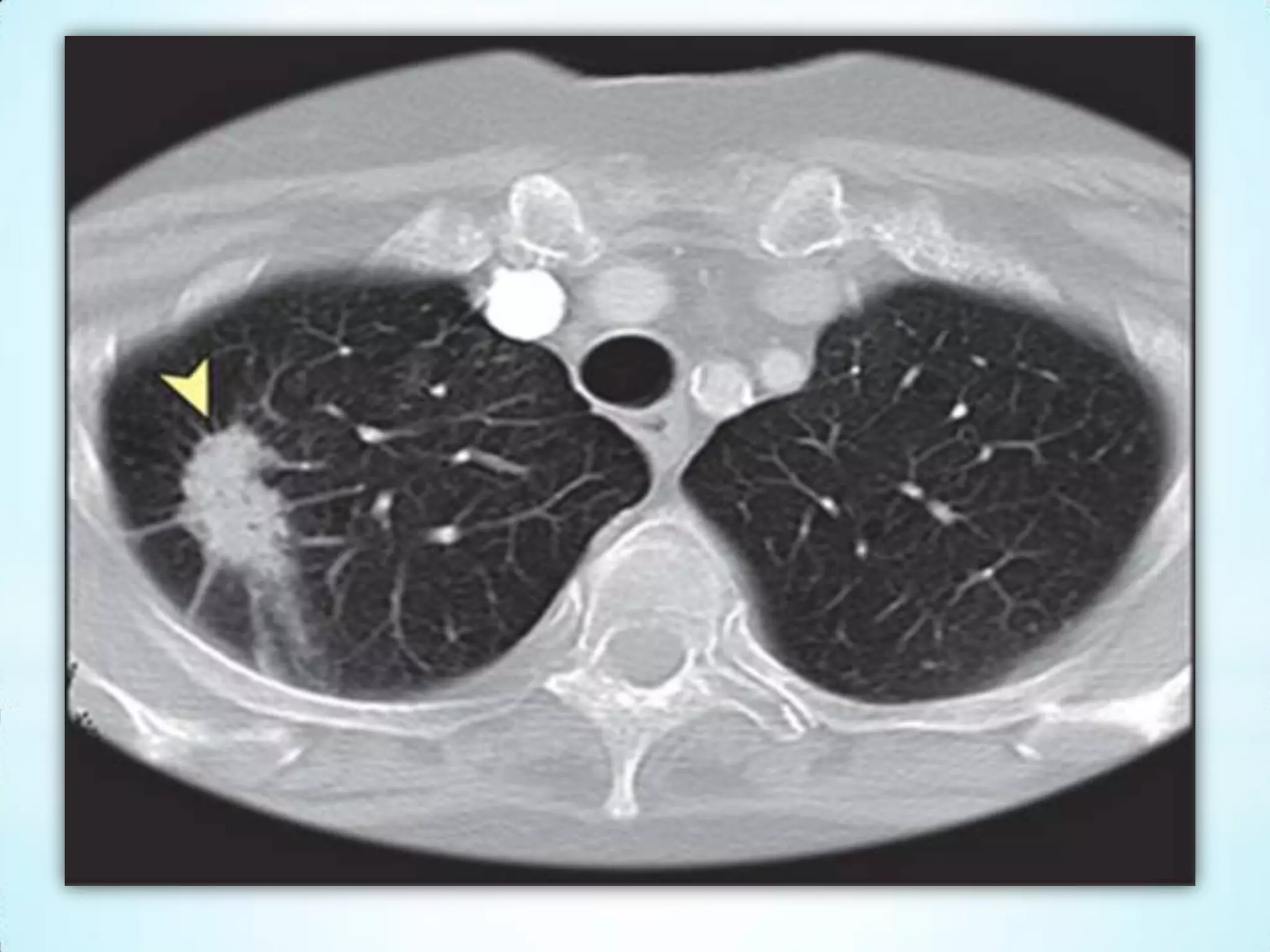 Doenças Cardiovasculares