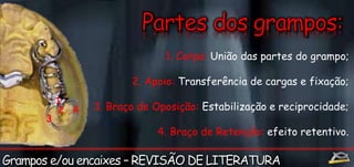 1 
2 
3 
4 
1. Corpo: União das partes do grampo; 
2. Apoio: Transferência de cargas e fixação; 
3. Braço de Oposição: Estabilização e reciprocidade; 
4. Braço de Retenção: efeito retentivo. 
 