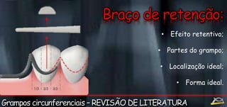• Efeito retentivo; 
• Partes do grampo; 
• Localização ideal; 
• Forma ideal. 
 