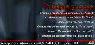 • Grampo circunferencial simples ou de Ackers; 
• Grampo em Anzol ou “Hair- Pin Clasp”; 
• Grampo circunferencial reverso; 
• Grampo circunferencial em Anel ou “Ring Clasp”; 
• Grampo Meio a Meio ou “Half or Half”; 
• Grampo de ação posterior ou “Black action”; 
 