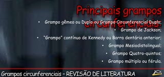 • Grampo gêmeo ou Duplo ou Grampo Circunferencial Duplo; 
• Grampo de Jackson; 
• “Grampo” contínuo de Kennedy ou Barra dentária anterior; 
• Grampo Mesiodistolingual; 
• Grampo Quatro-quintos; 
• Grampo múltiplo ou férula. 
 