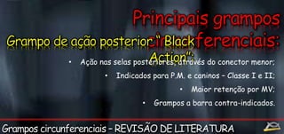 • Ação nas selas posteriores, através do conector menor; 
• Indicados para P.M. e caninos – Classe I e II; 
• Maior retenção por MV; 
• Grampos a barra contra-indicados. 
 